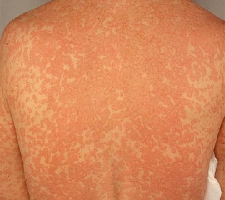 Amoxil amoxil rash pictures medication