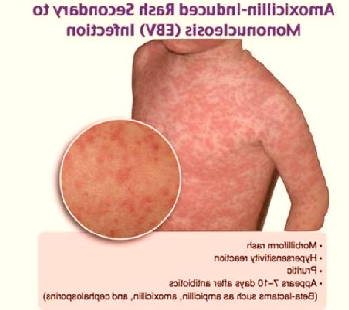 Amoxil amoxil rash pictures pharmacy