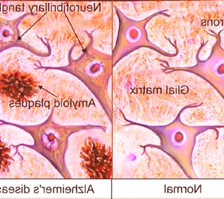 Celexa celexa and amyloid buildup in brain tablet