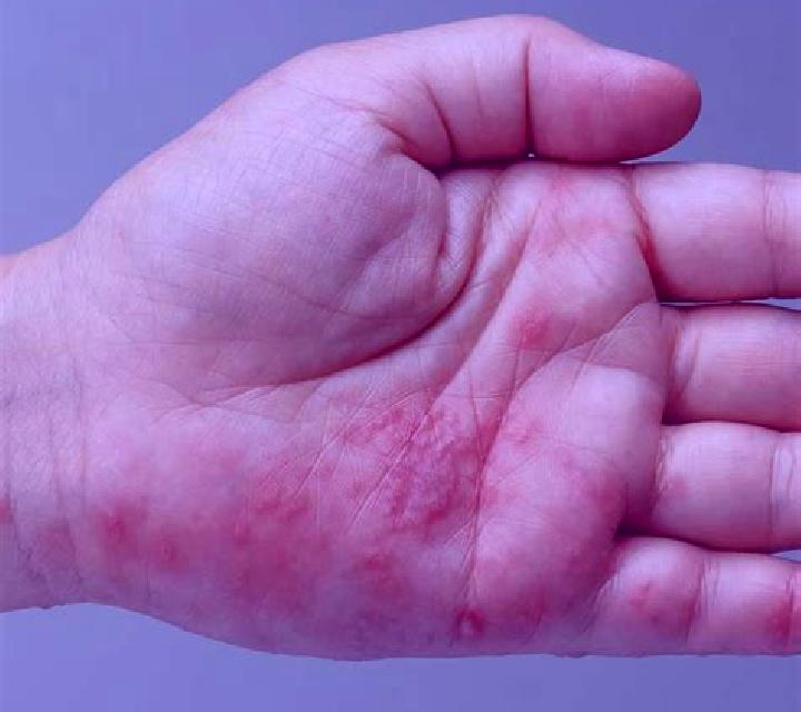 Champix rash on hands champix pharmacy