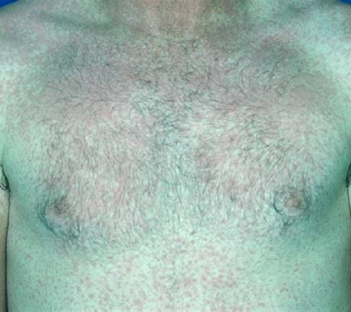 Cialis cialis side effects skin rash medication