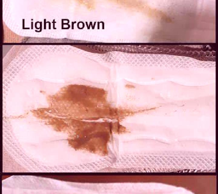 Flagyl brown discharge after flagyl pharmacy