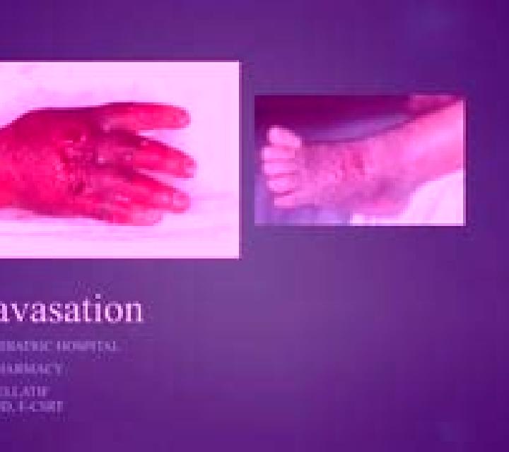 Flagyl flagyl extravasation treatment pharmacy