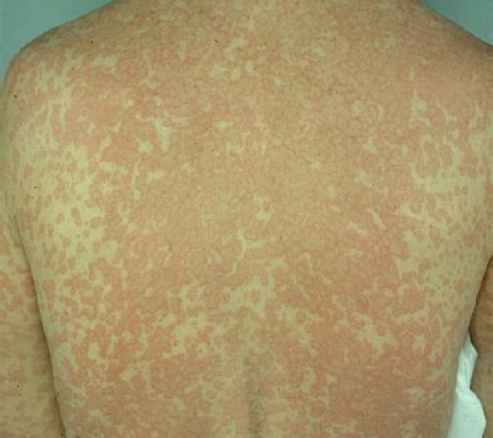 Flagyl flagyl skin reaction medication