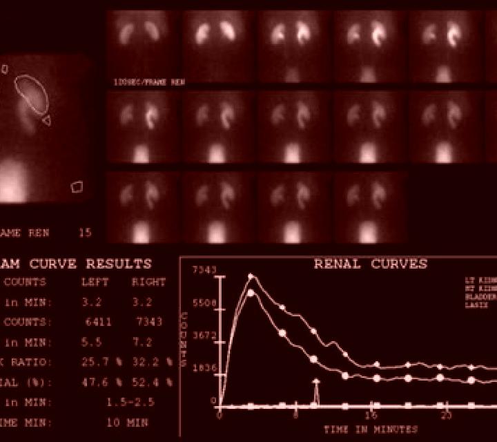 Lasix abnormal lasix renal scan medication