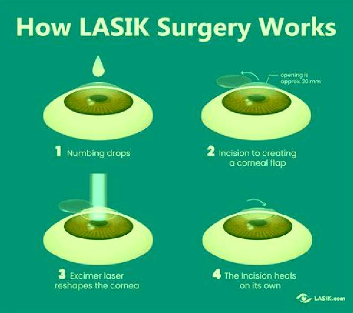 Lasix does medicare cover lasix eye surgery tablet