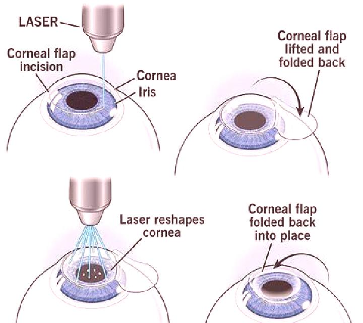 Lasix lasix after ablation pharmacy