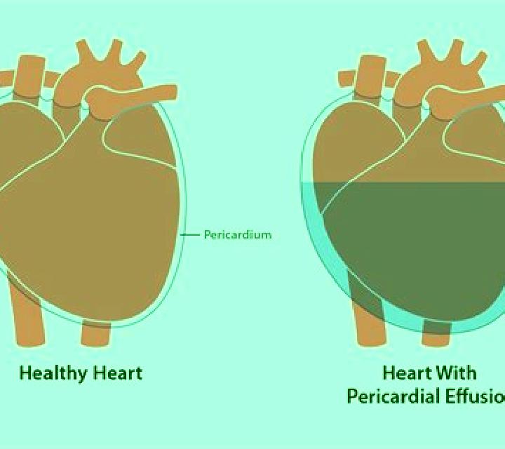 Lasix lasix for pericardial effusion medication