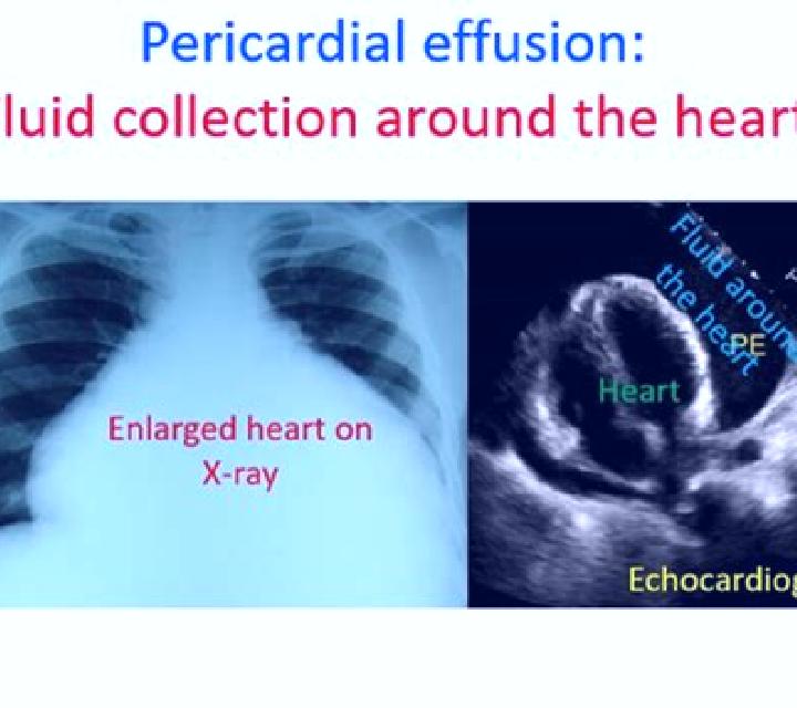 Lasix lasix for pericardial effusion pharmacy