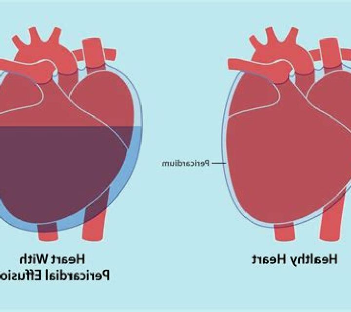 Lasix lasix for pericardial effusion pills