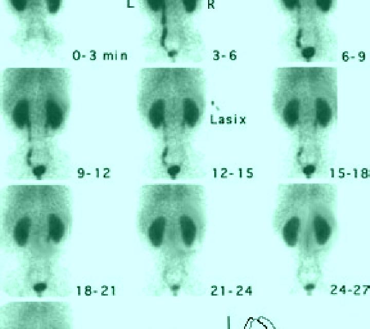 Lasix lasix washout renal scan pills