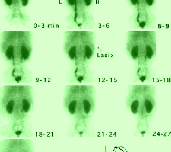 Lasix nm renal scan with lasix cpt pharmacy