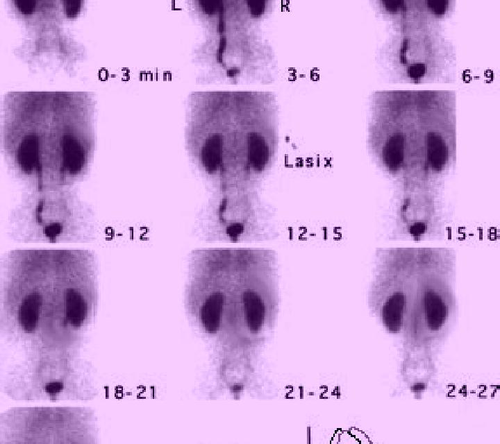 Lasix nuclear medicine lasix renal scan protocol medication