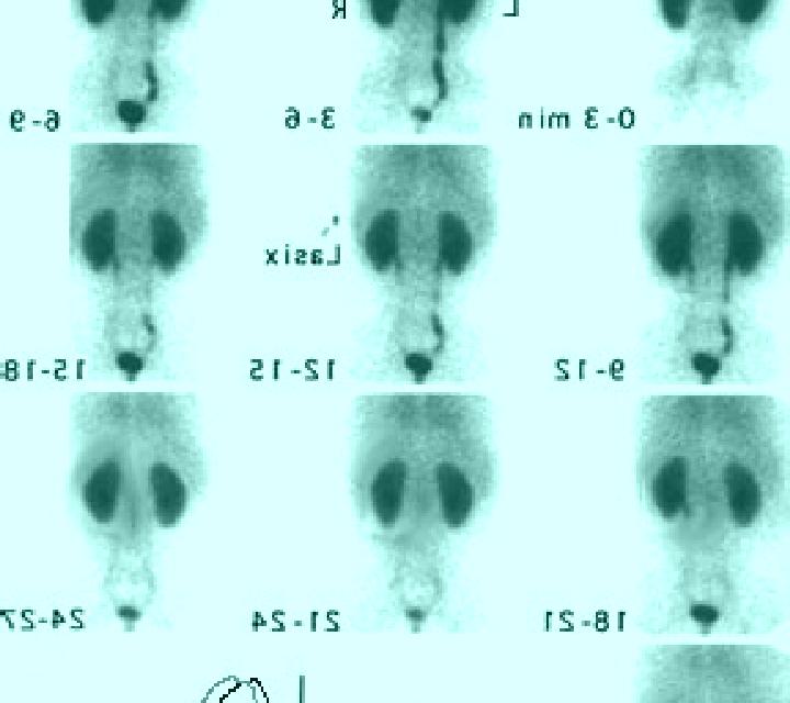 Lasix renal scan with lasix normal results pharmacy