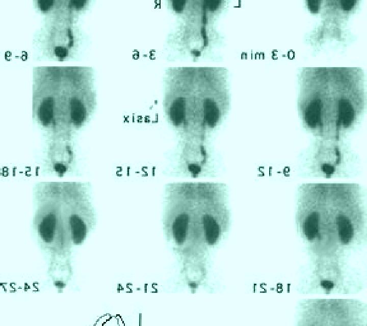 Lasix renal scan with lasix normal results tablet