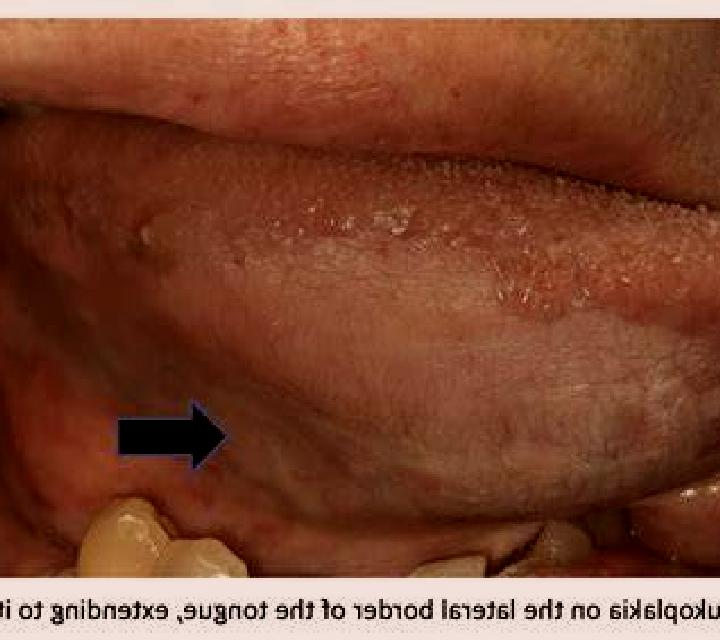 Levitra levitra under the tongue or swallowed pills