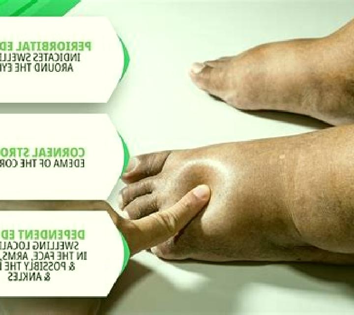 Neurontin neurontin leg edema medication