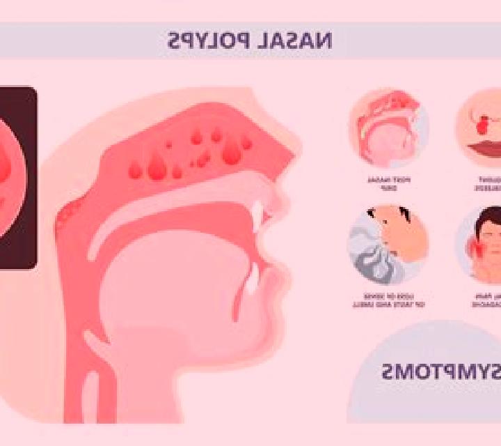 Prednisolone nasal polyps prednisolone worked pharmacy