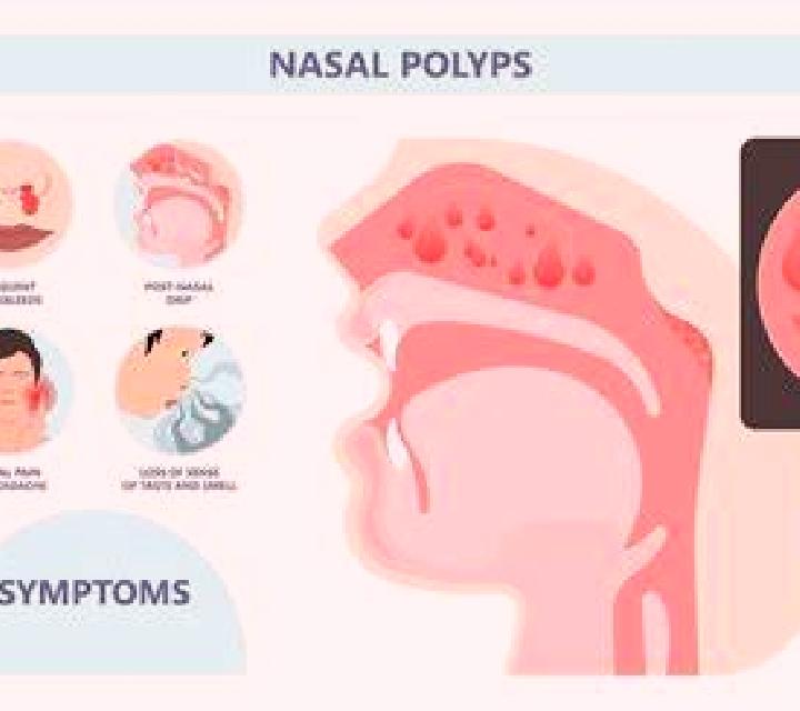 Prednisolone nasal polyps prednisolone worked tablet