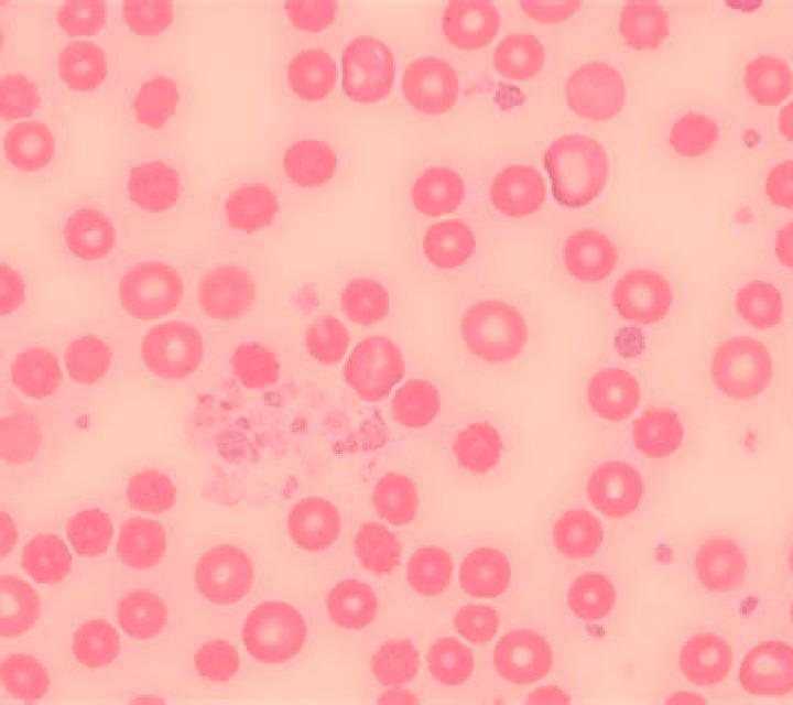Prednisolone platelet clumping prednisolone pharmacy