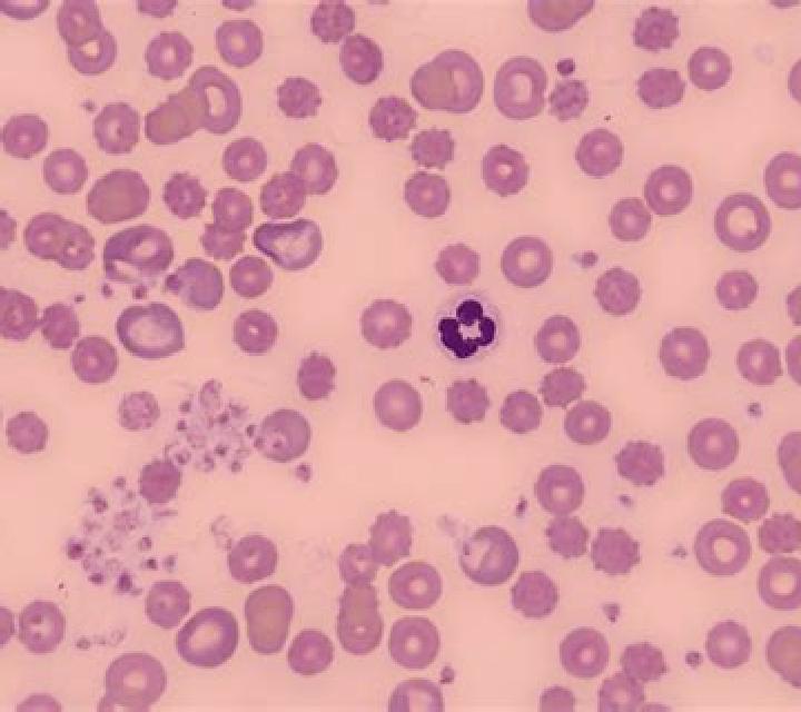 Prednisolone platelet clumping prednisolone pills