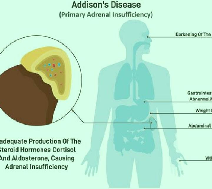 Prednisolone prednisolone causing iatrogenic addison s disease tablet