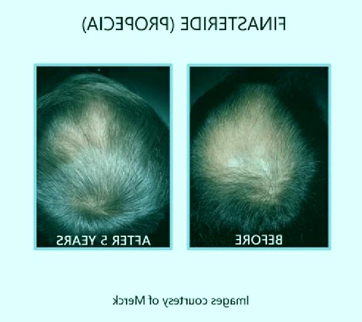 Propecia changing from propecia to finasteride medication