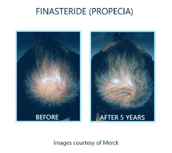Propecia does generic finasteride work as well as propecia tablet