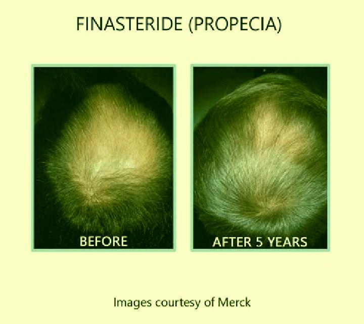 Propecia does propecia inhibit muscle growth tablet