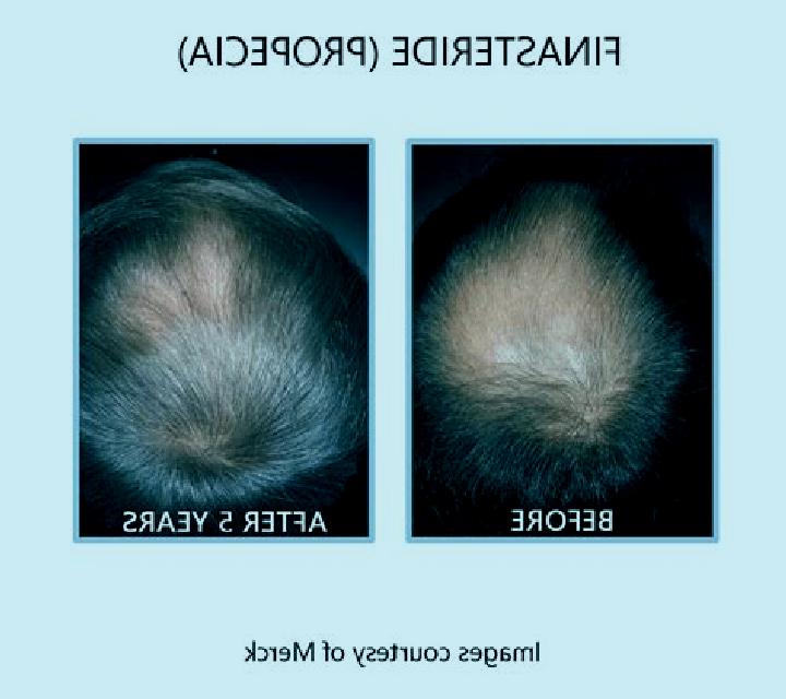 Propecia does propecia mask prostate cancer pills