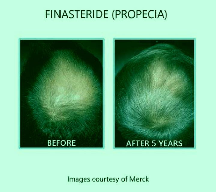 Propecia go bald or take propecia pills