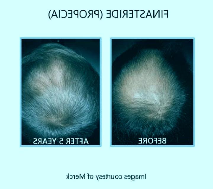 Propecia is propecia more effective tham minodoxil medication