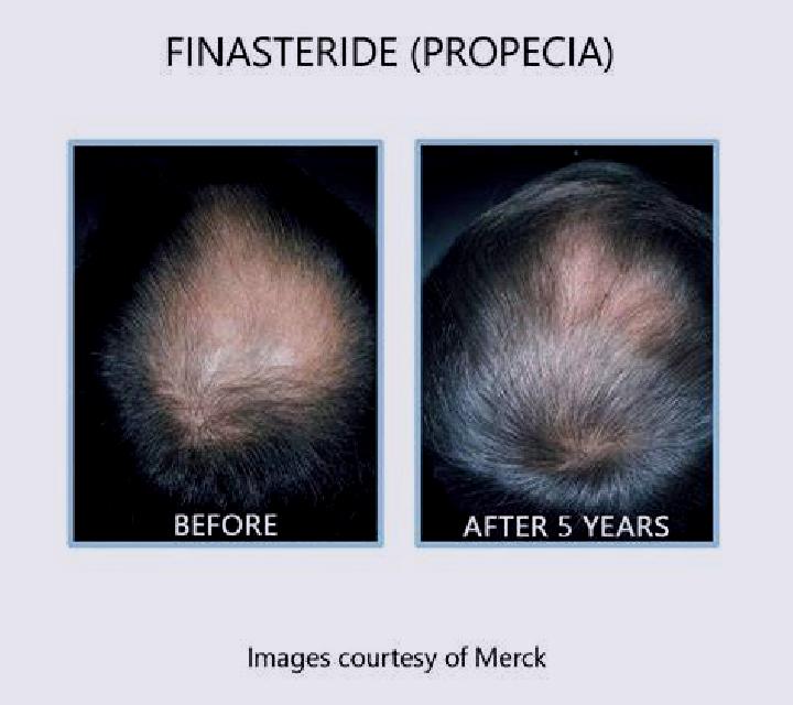 Propecia keep hair growing while on propecia medication
