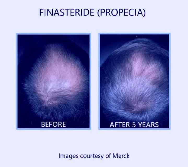 Propecia keep hair growing while on propecia pills