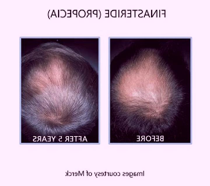 Propecia minoxidil and propecia before and after medication