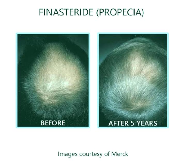 Propecia minoxidil and propecia before and after pharmacy