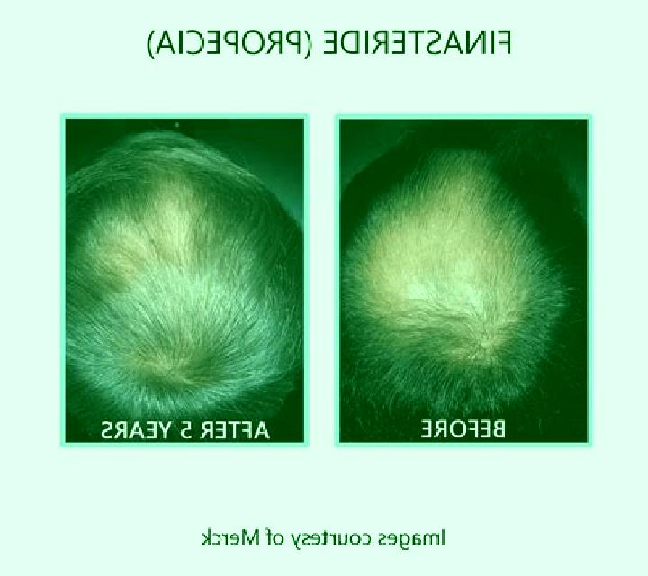 Propecia minoxidil and propecia before and after pills