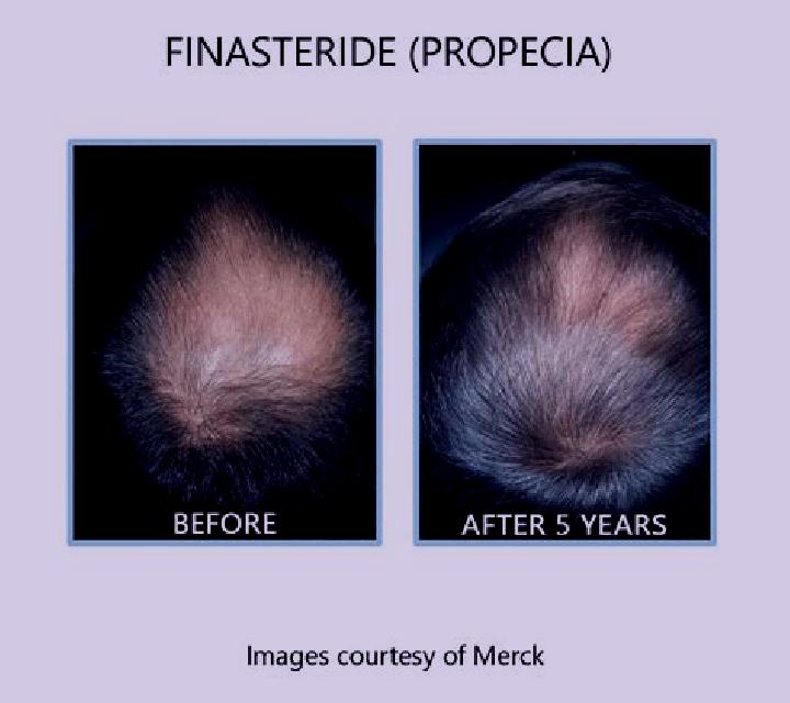 Propecia minoxidil and propecia before and after tablet