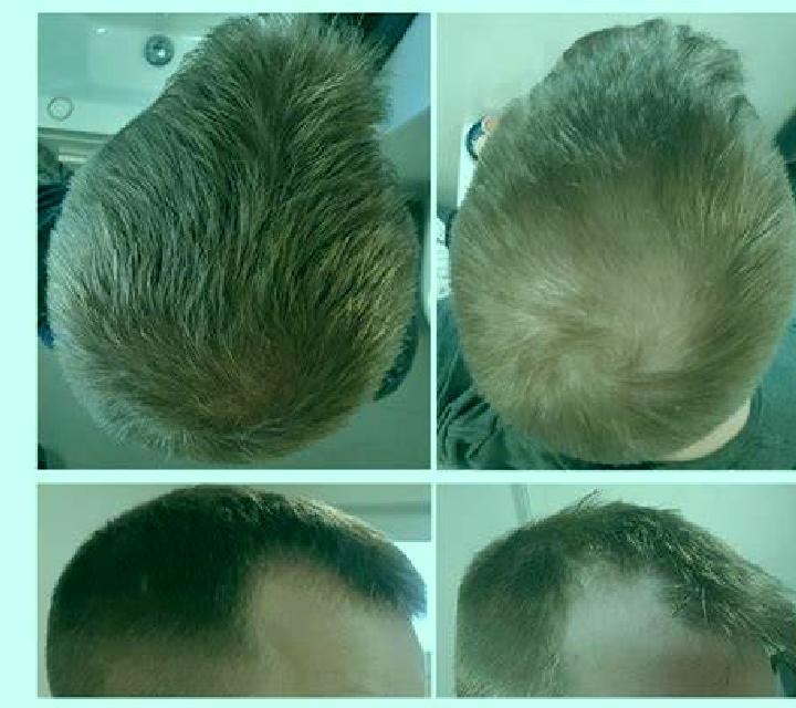 Propecia propecia 10 year results medication