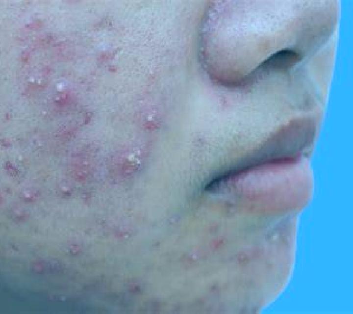 Propecia propecia acne induced pharmacy