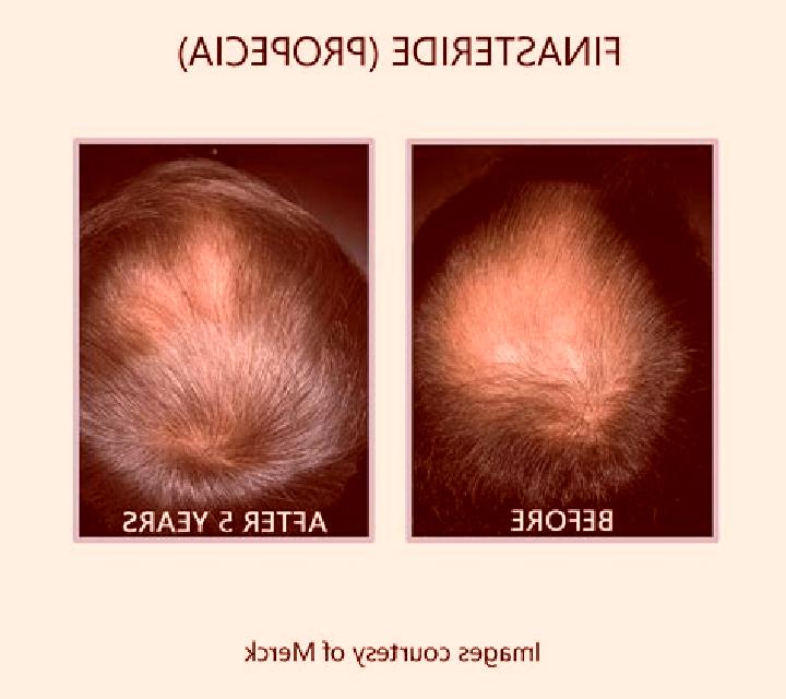 Propecia propecia before and after pharmacy