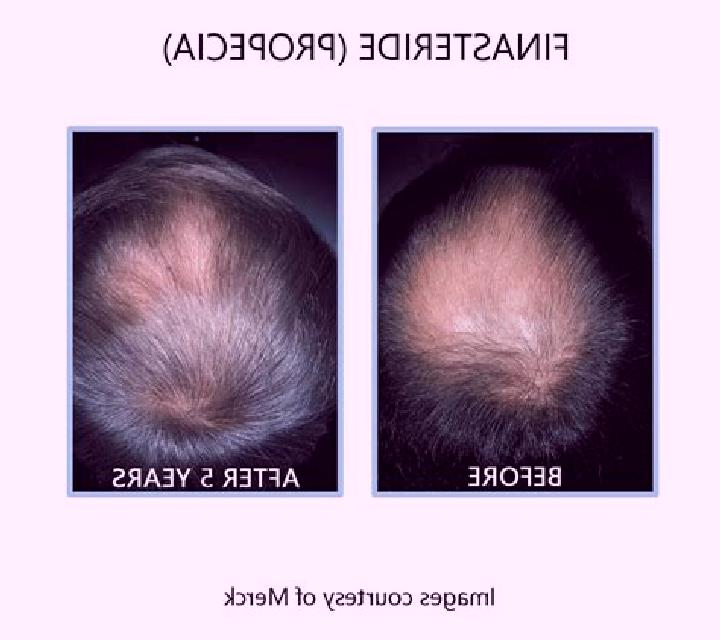 Propecia propecia before and after tablet