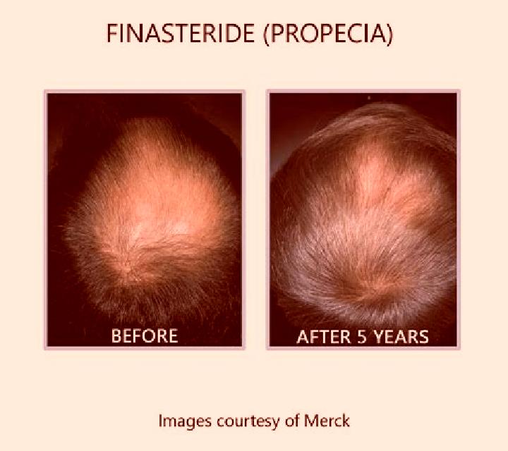 Propecia propecia crown before and after pharmacy