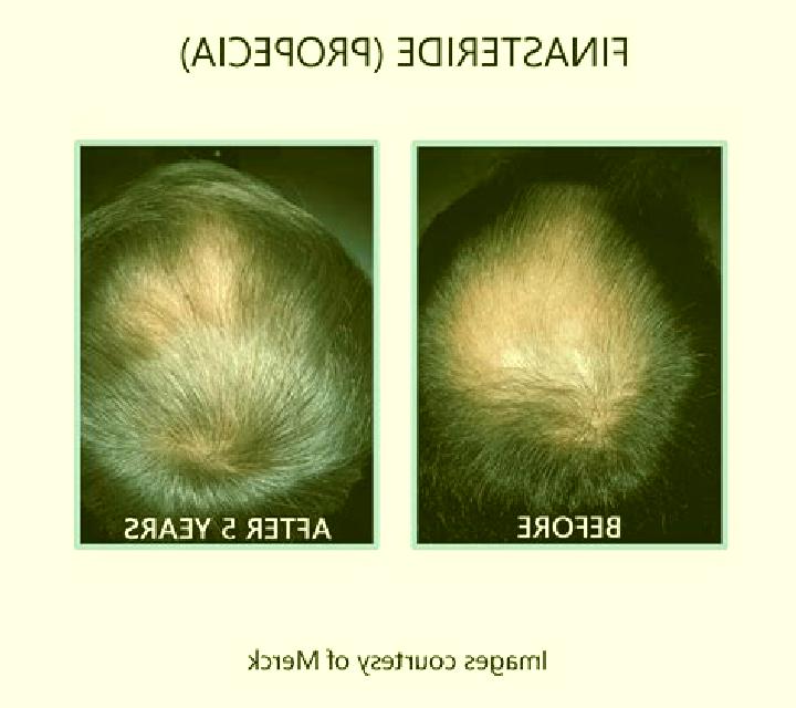 Propecia propecia crown before and after tablet
