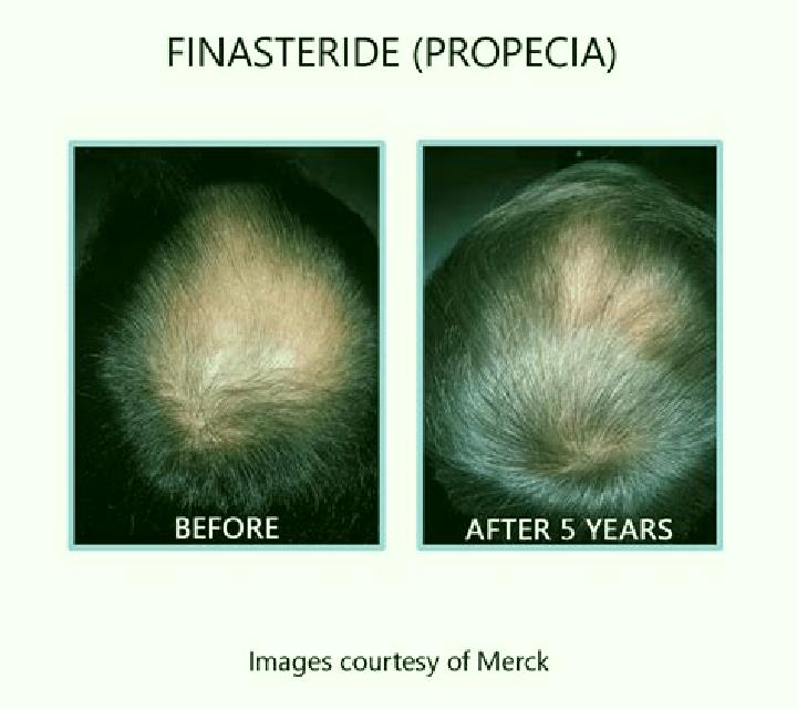 Propecia propecia finasteride before and after pharmacy