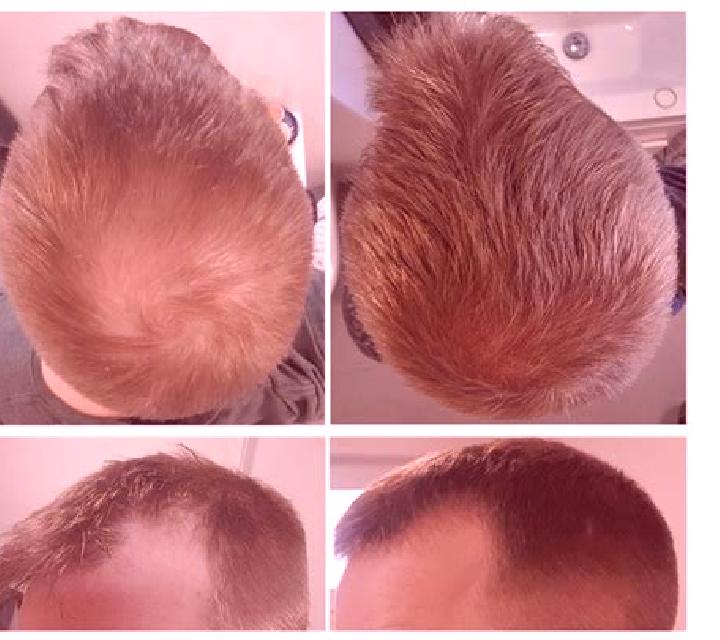 Propecia propecia frontal results pharmacy