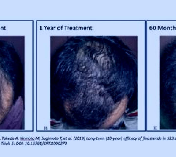 Propecia propecia long term results pharmacy