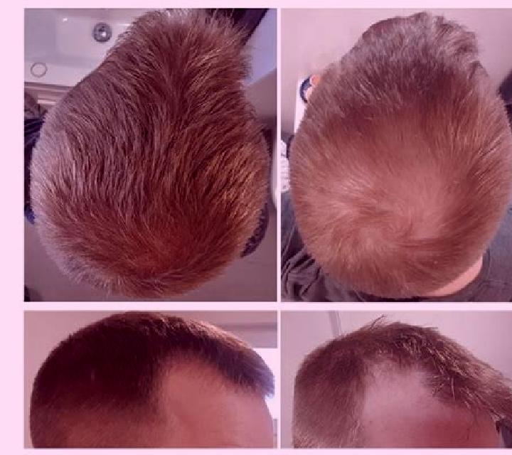 Propecia propecia regrowth 3 months pharmacy