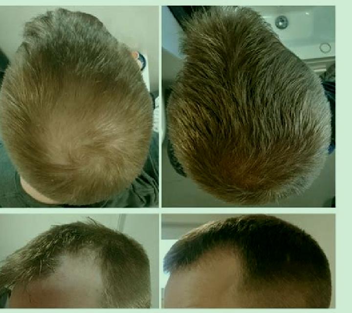 Propecia propecia results 3 months tablet
