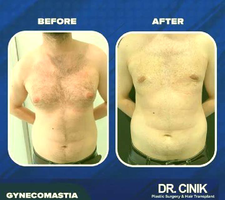 Propecia propecia side effects gynecomastia medication